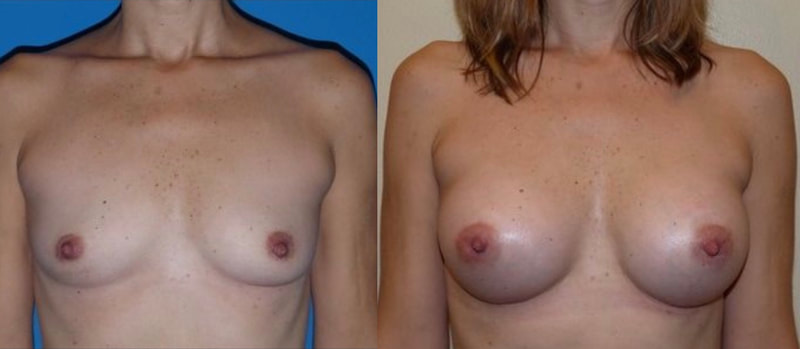 Breast implant before & after 8