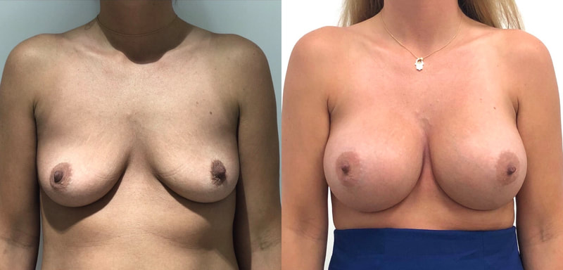 Breast implant before & after 9