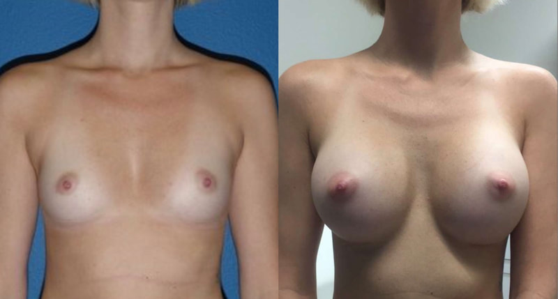 Breast implant before & after 6
