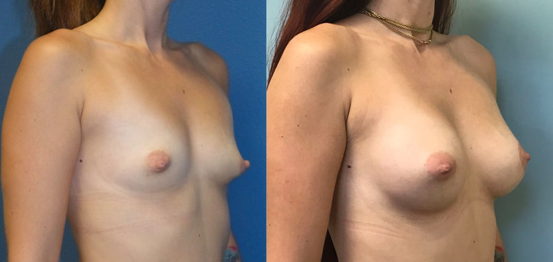 Breast implant before & after 12