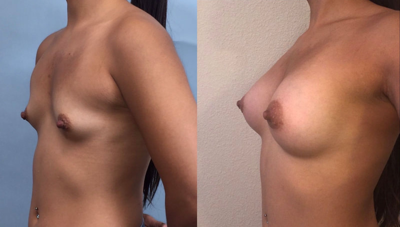 Breast implant before & after 13