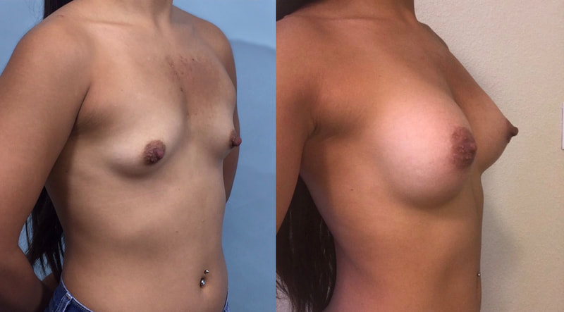 Breast implant before & after 14