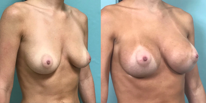 Breast implant before & after 15