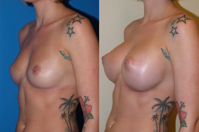 Breast implant before & after 16