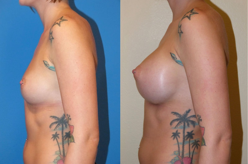 Breast implant before & after 19