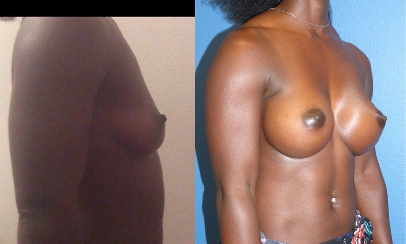 Breast implant before & after 21
