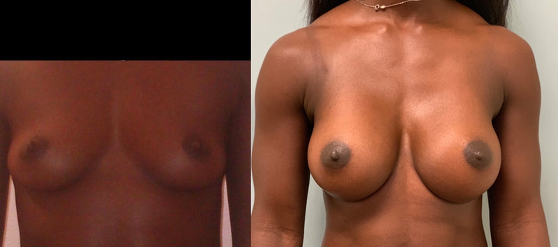 Breast implant before & after 23