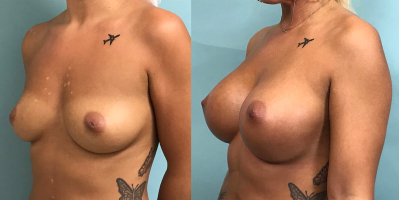 Breast implant before & after 24