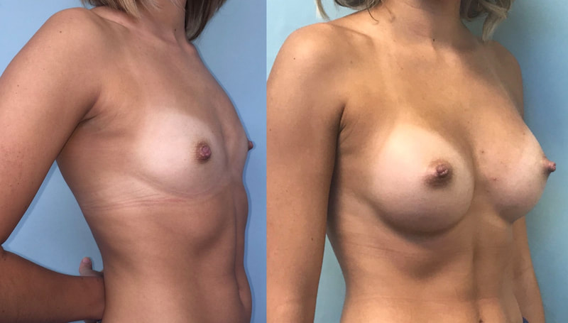 Breast implant before & after 26