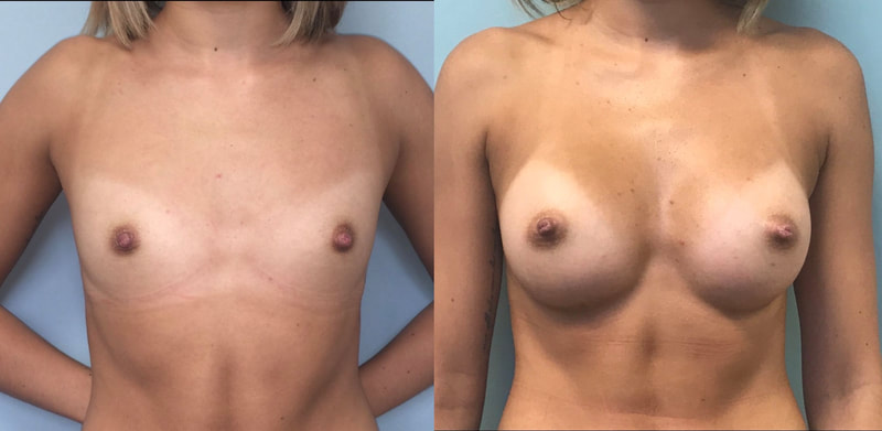 Breast implant before & after 27