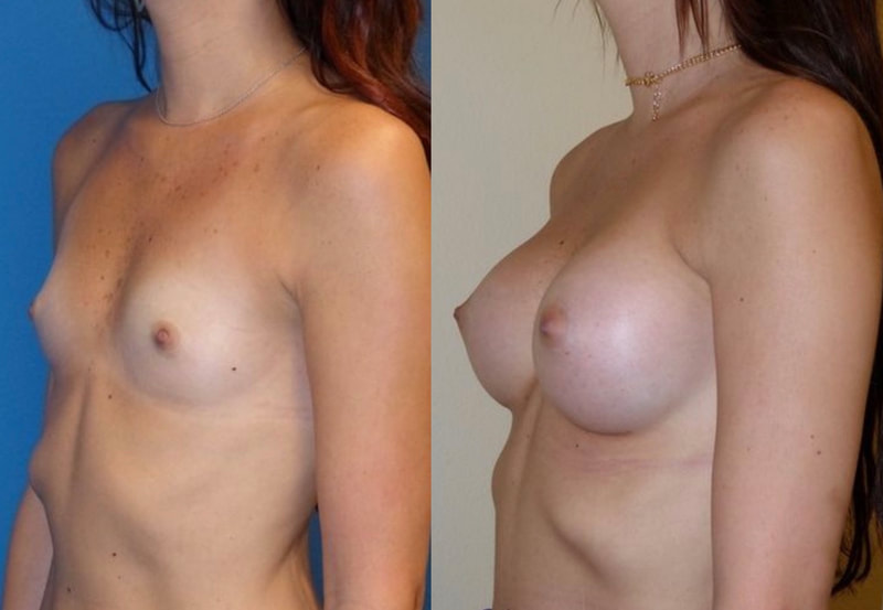 Breast implant before & after 11