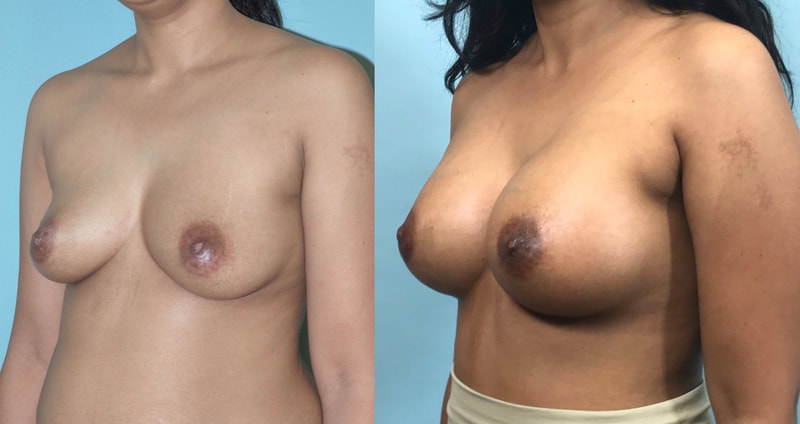 Breast implant before & after 28