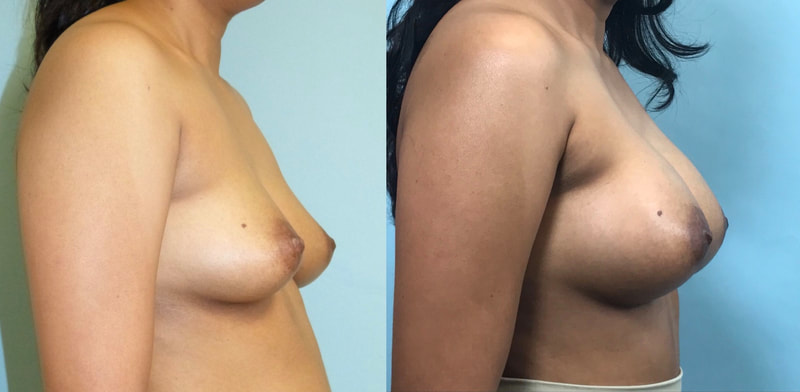 Breast implant before & after 29