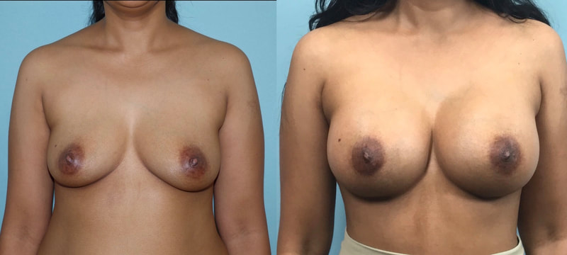 Breast implant before & after 30