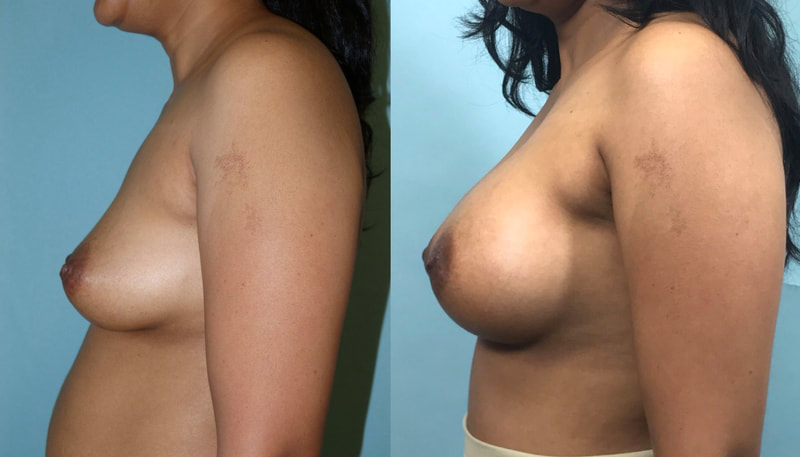 Breast implant before & after 31