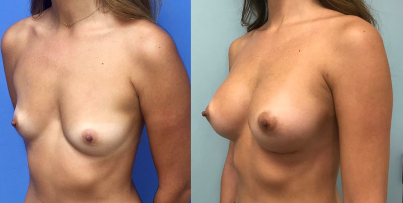 Breast implant before & after 4