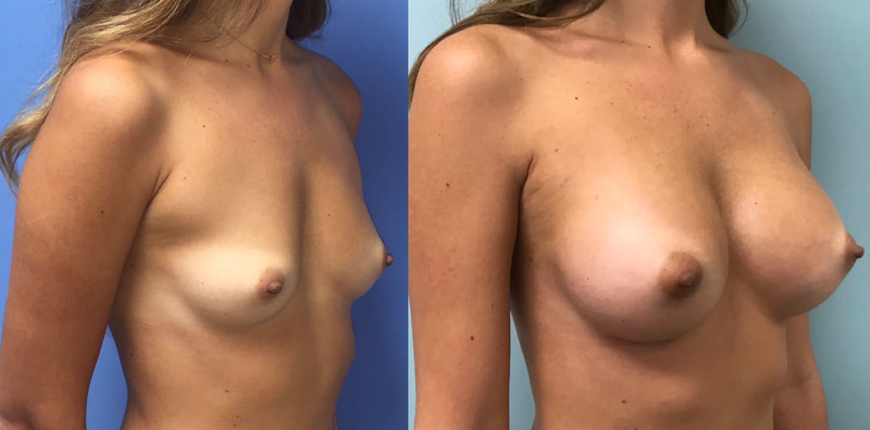 Breast implant before & after 5