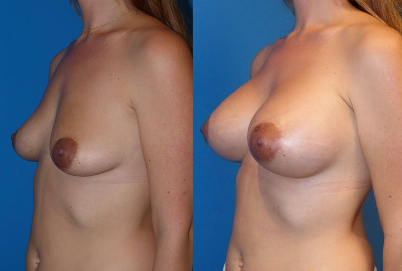 Breast implant before & after 31
