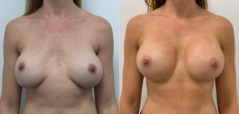 Breast implant before & after 34