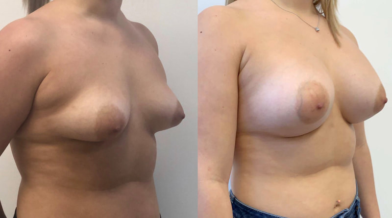 Breast implant before & after 35