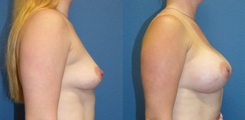 Breast implant before & after 61