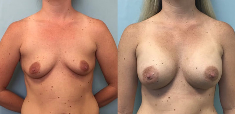 Breast implant before & after 62