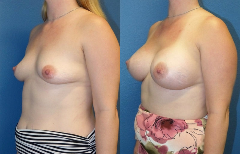 Breast implant before & after 64