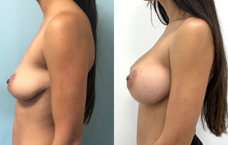 Breast implant before & after 65