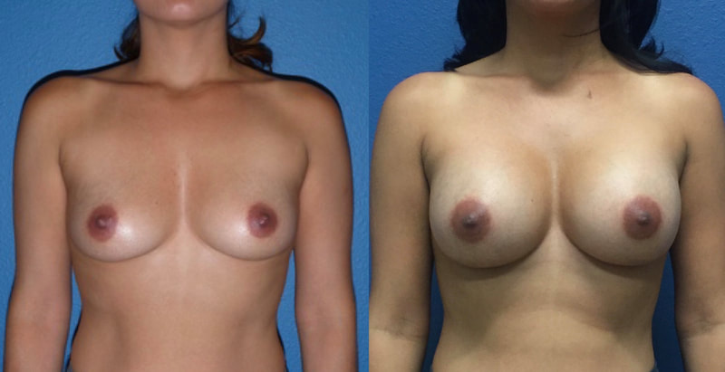Breast implant before & after 67