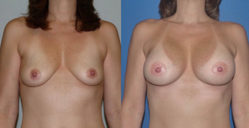 Breast implant before & after 70