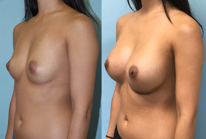 Breast implant before & after 73
