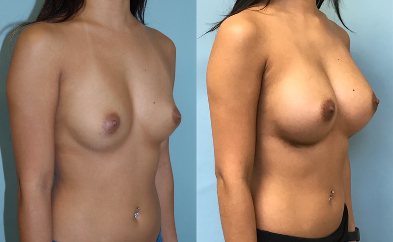 Breast implant before & after 74