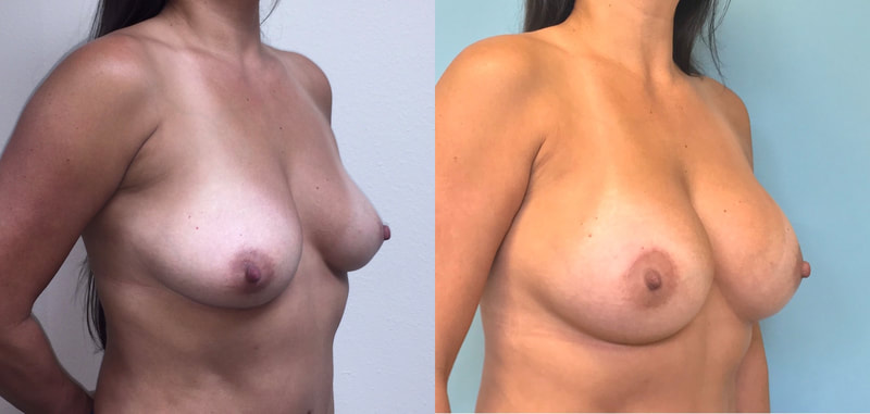 Breast implant before & after 76