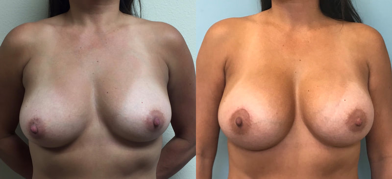Breast implant before & after 77