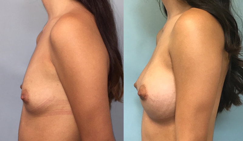 Breast implant before & after 80
