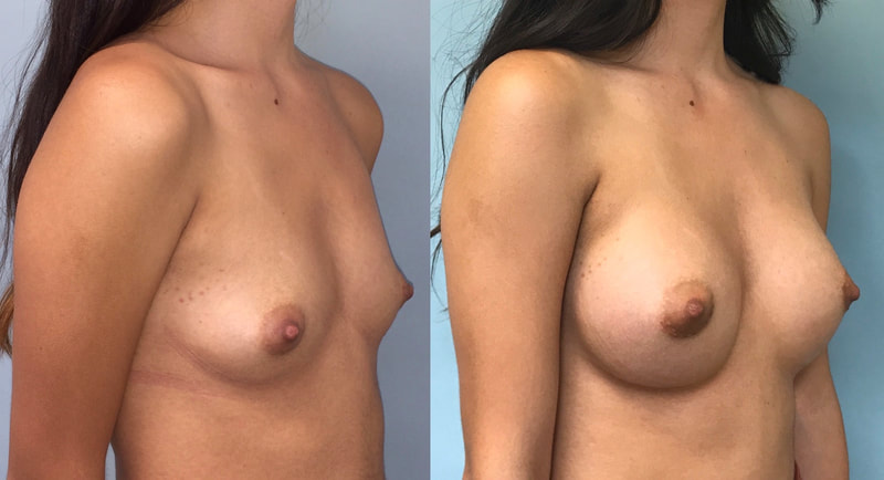 Breast implant before & after 81