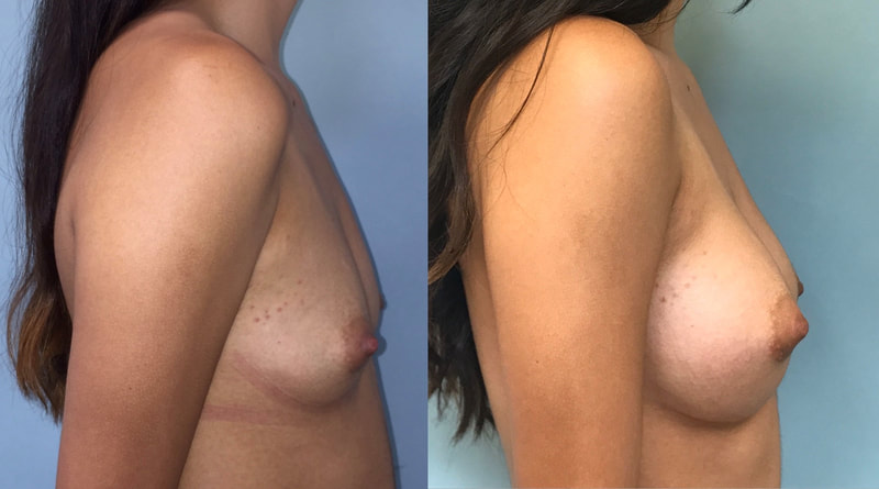 Breast implant before & after 82