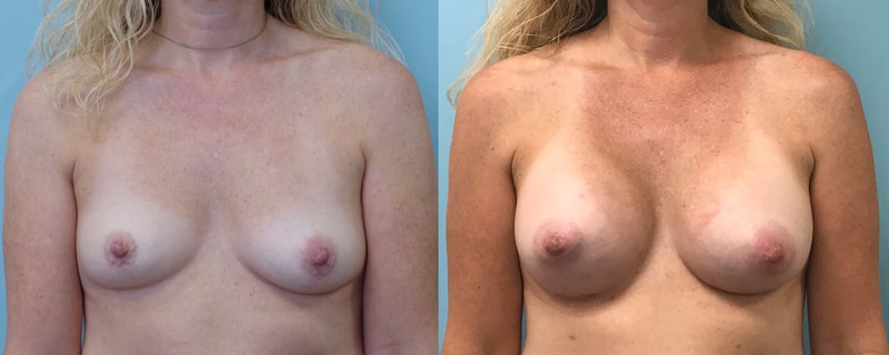 Breast implant before & after 84