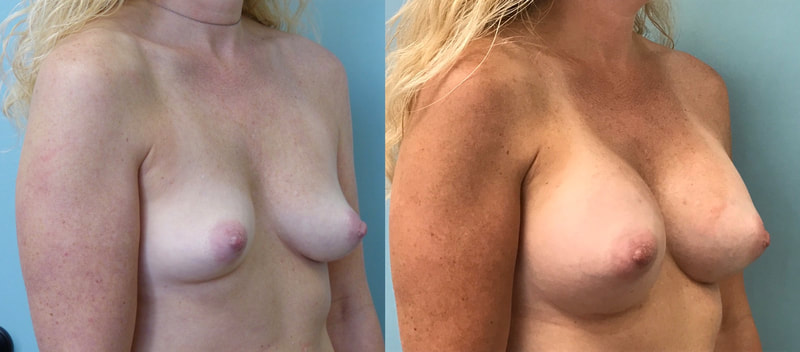Breast implant before & after 85