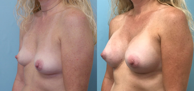 Breast implant before & after 86