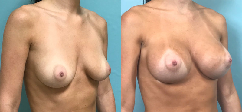 Breast implant before & after 90