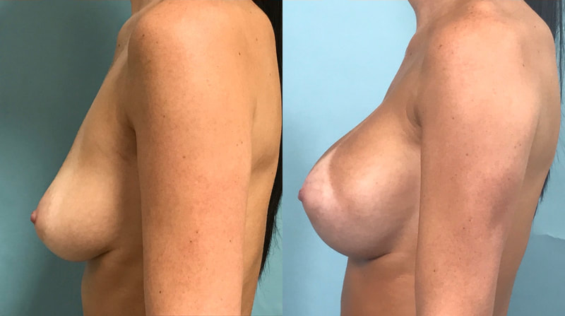 Breast implant before & after 900