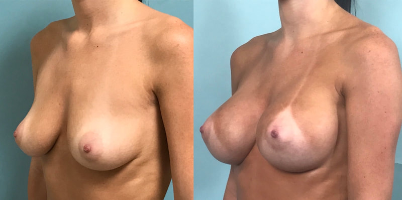 Breast implant before & after 901