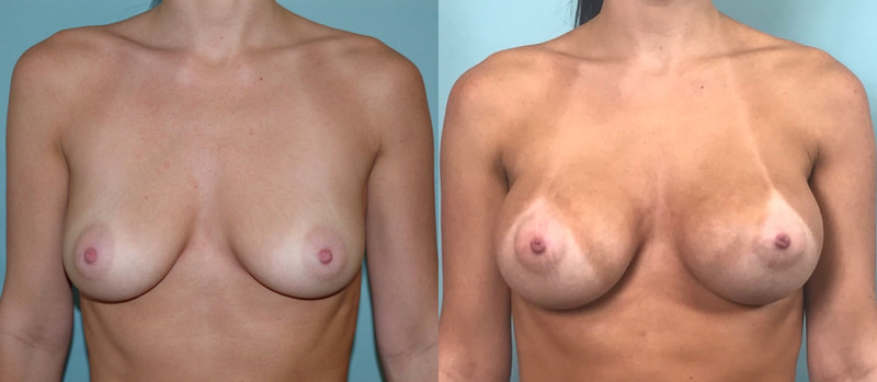 Breast implant before & after 91