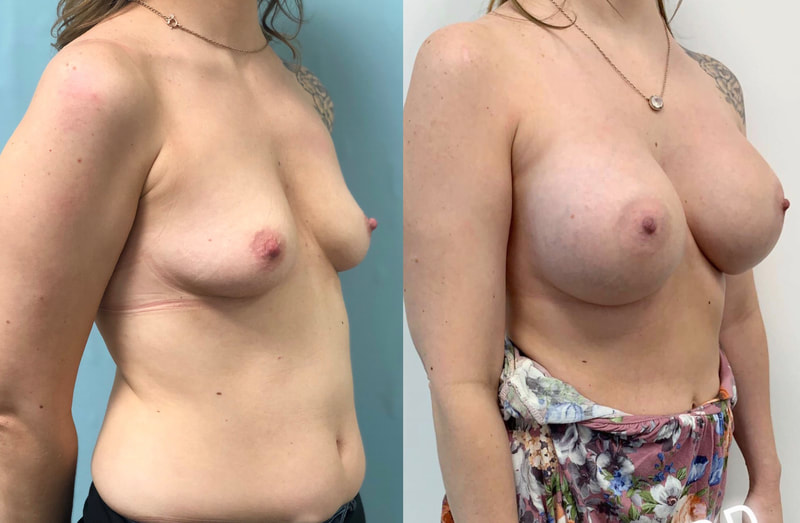 Breast implant before & after 93