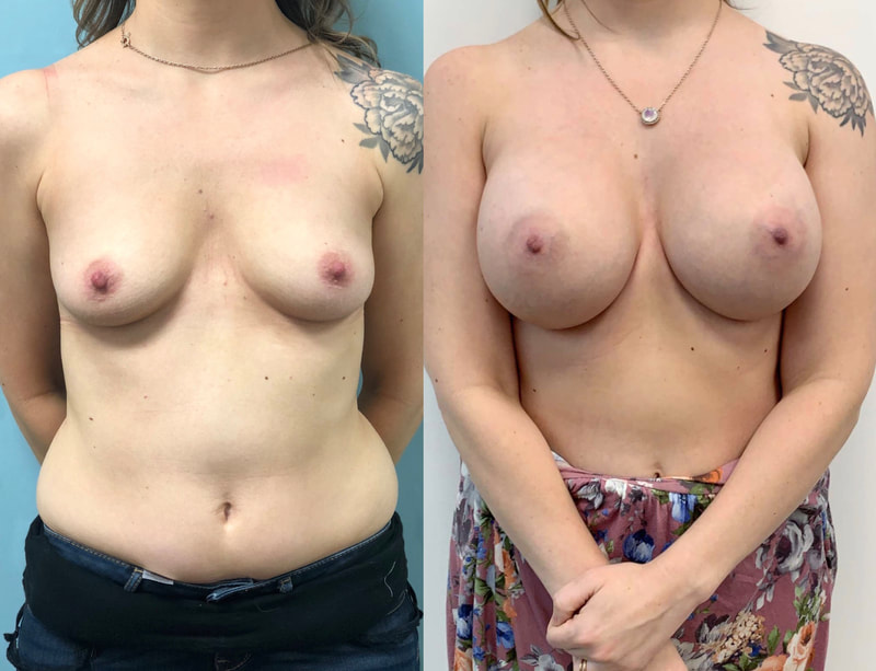 Breast implant before & after 94