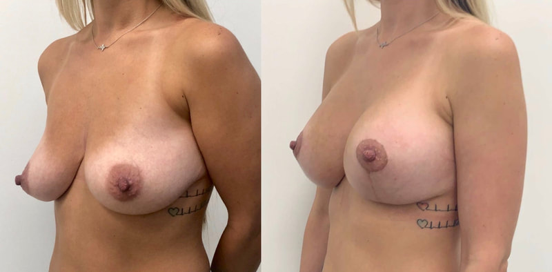 Breast implant before & after 96