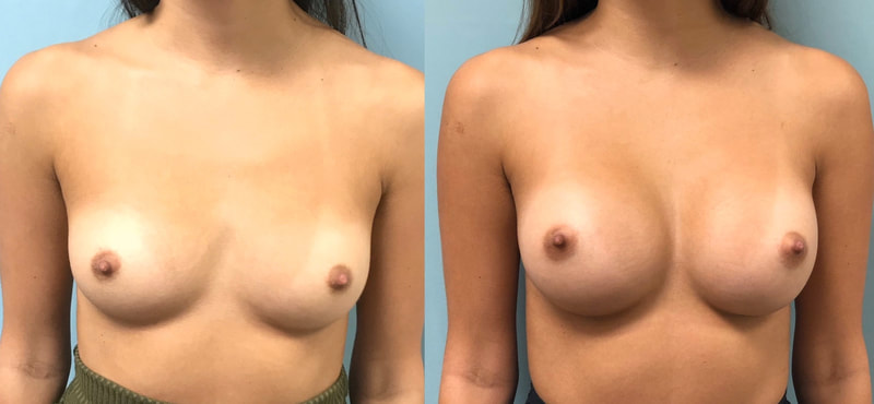 Breast implant before & after 99