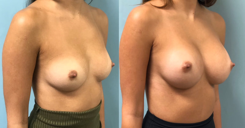 Breast implant before & after 100