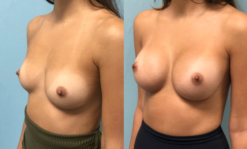 Breast implant before & after 101